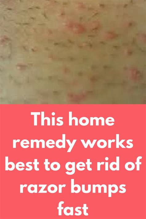 This Home Remedy Works Best To Get Rid Of Razor Bumps Fast Prevention