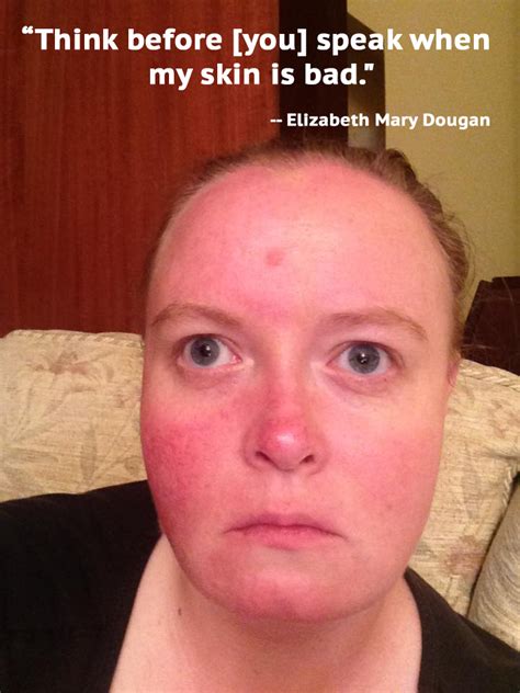 17 Things People With Rosacea Wish You Understood
