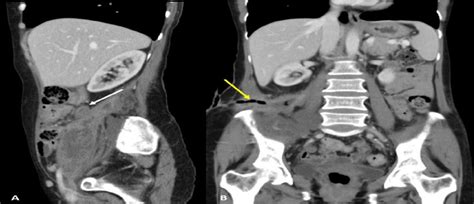 Contrast Enhanced Ct Scan Sagittal Images A Reveal A Thick Walled