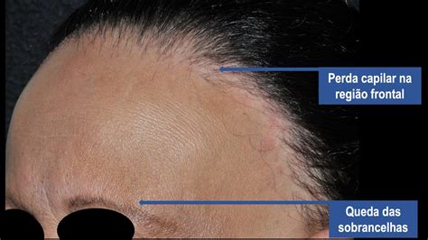 Alopecia Frontal Fibrosante Sinais Causas E Tratamento Dr Paulo Muller