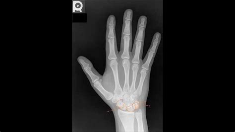 Hand Bone Anatomy On Xray