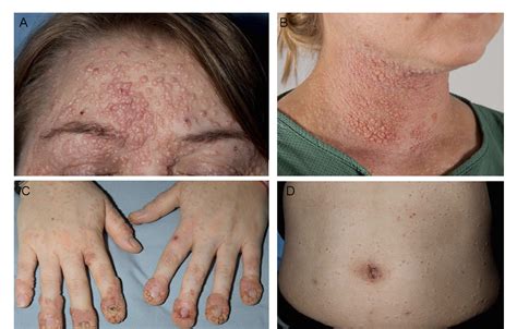 Figure 2 From Detection Of Molluscum Contagiosum Virus Mcv Dna In The