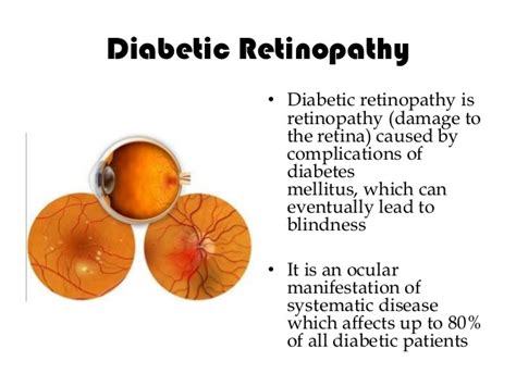 Diabetes And The Eyes View Optometry Optometrist In North Vancouver
