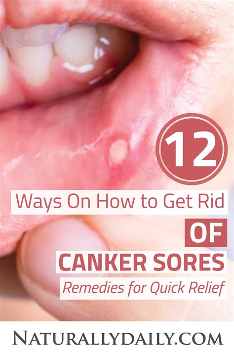 12 Ways On How To Get Rid Of Canker Sores Remedies For Quick Relief Canker Sore Causes