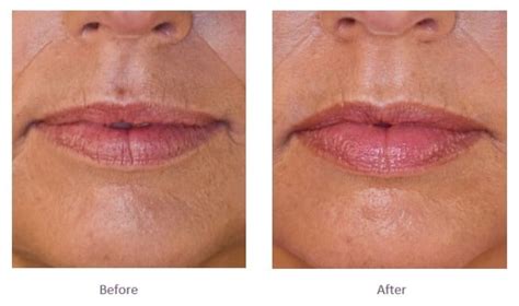 Lip Filler Before And After Lip Fillers London Buckinghamshire The