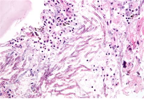 Fungal Infections Flashcards Quizlet