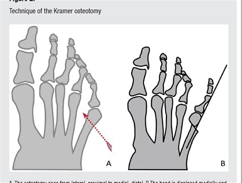 Figure 2 From Minimally Invasive Osteotomy For Symptomatic Bunionette
