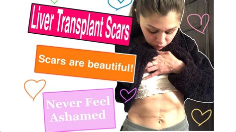 My Liver Transplant Scars How Scars Are Formed Treatments Etc