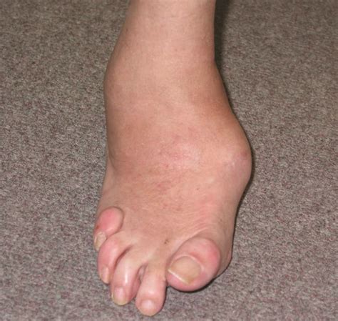 Managing Complications Of The Diabetic Foot The Bmj