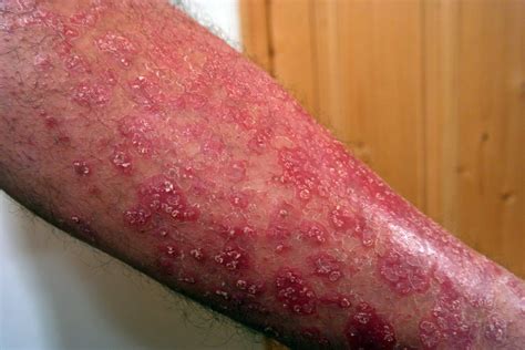 psoriasis what is it pictures causes symptoms treatment i need medic