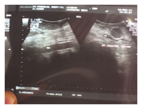 Ultrasound Of Enlarged Right Inguinal Lymph Node 25×2 Cm Download