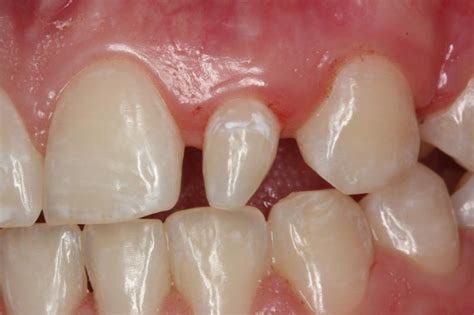 Microdontia Dentagama Dental Dentes