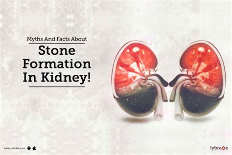 Myths And Facts About Stone Formation In Kidney By Dr Rahul Poddar