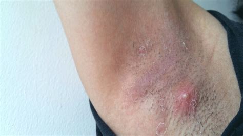 Underarm Rash Causes Pictures Painful Red And Itchy Rash
