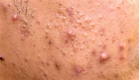 Types Of Acne Skin Problems Papule In Cross Section Side View And Top