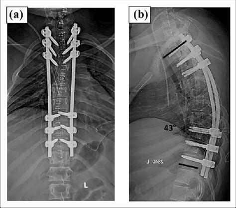 Posterior Cervical Spine Fusion