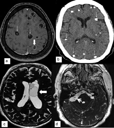 Imaging Of Parenchymal And Extraparenchymal Neurocysticercosis A Mri