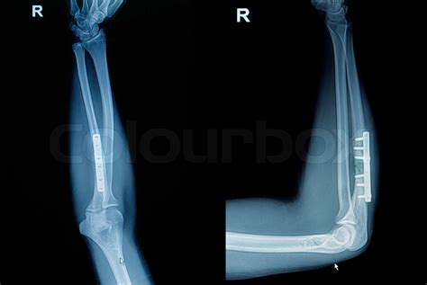 Film X Ray Wrist Fracture Show Fracture Radius Bone Forearms Bone With Inserted Plate And
