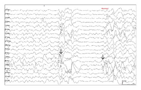 Hypsarrhythmia The Typical Interictal Eeg Finding Consists Of A