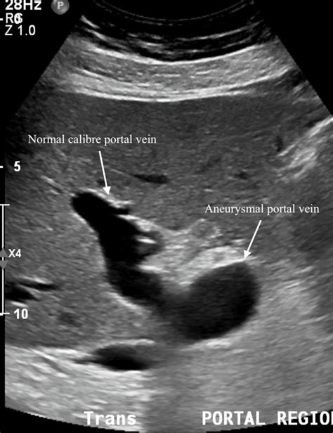 Portal Venous Aneurysm Bmj Case Reports