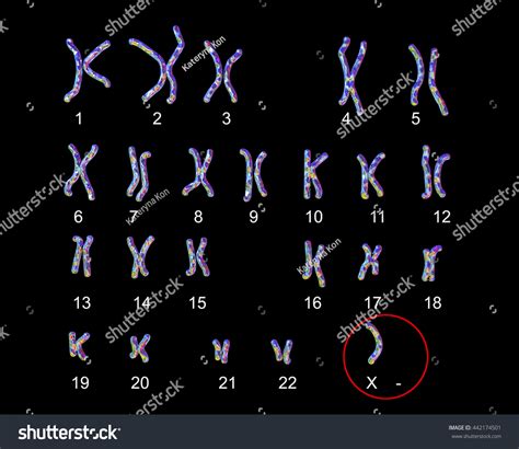 Turnerssyndrome Karyotype Labeled X Karyotype D