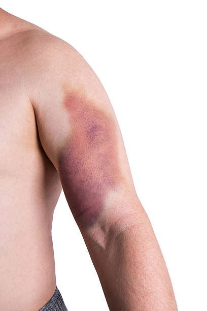Hemorrhage Bruise Human Arm Physical Injury Stock Photos Pictures