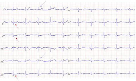 Electrocardiogram Showing Sinus Rhythm With Convex St Elevation In The