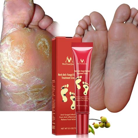 Herbal Foot Treatment Anti Fungal Infection Onychomycosis Paronychia