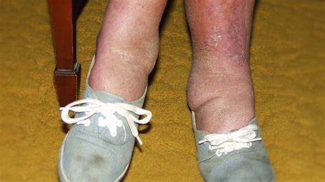 Liver Disease And Swollen Ankles