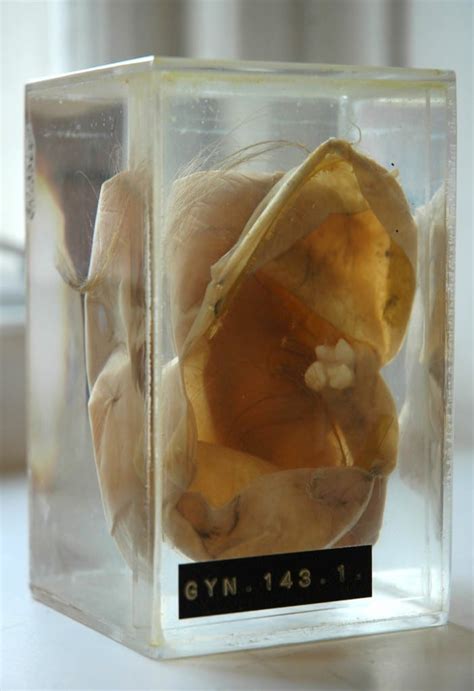 Ovarian Dermoid Cysts Ucl Researchers In Museums