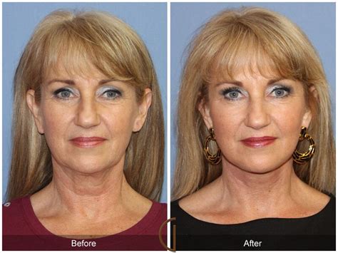 Facelift Fifties Before And After Photos Patient 60 Dr Kevin Sadati