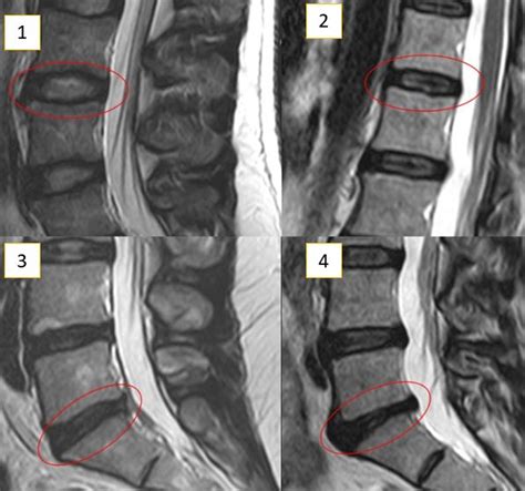 Columna Vertebral Linares Con Isidro