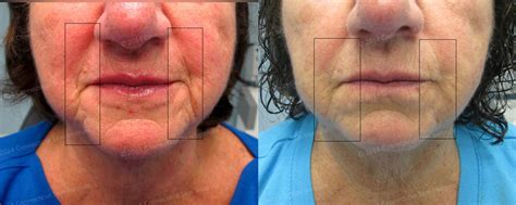 Filler Injections To Treat Wrinkles Connecticut Skin Institute