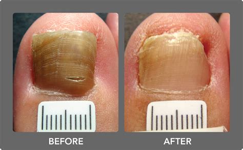 Nail Fungus Treatment Pictures To Pin On Pinterest
