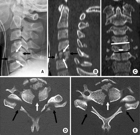 Burst Dispersion Axial Loading Fracture Of C5 Lateral Radiograph
