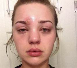 Young Woman Pops A Pimple Above Eye Then Staph Infection Almost
