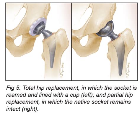 About Hip Replacement MU Health Care