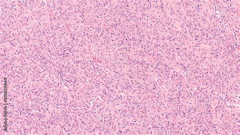 Photomicrograph Of A Solitary Fibrous Tumor A Type Of Soft Tissue