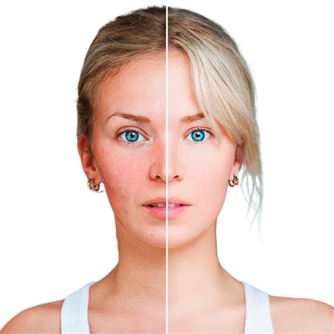 Ruddy Skin And Rosacea Ruddy Skin Is Often A Precursor To Rosacea