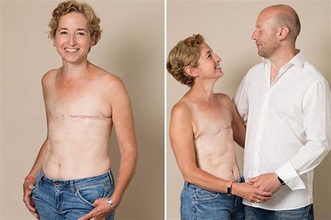 Brave Mum Poses Topless To Show Mastectomy Scars After Beating Breast