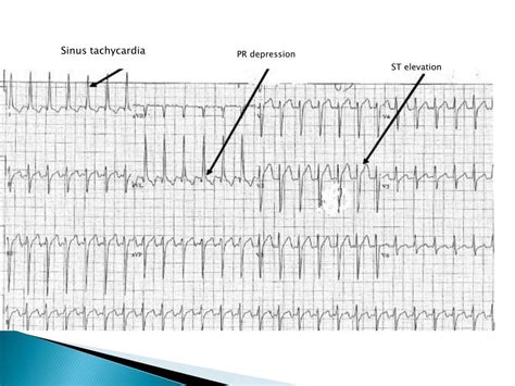 Ppt Endocarditis Pericarditis Powerpoint Presentation Free Download