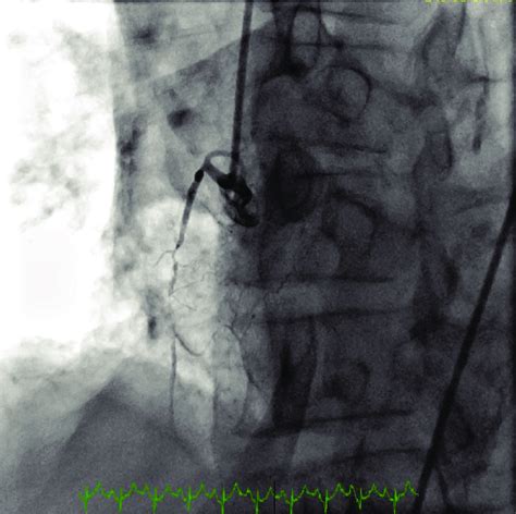 Left Heart Cath Showing Occlusion Of Rca With Collaterals From Left