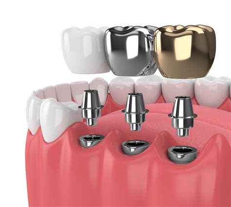 What Are The Best Types Of Dental Implants Healthy Smile Dental