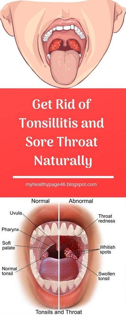 Get Rid Of Tonsillitis And Sore Throat Naturally Remedies For