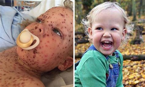 Chickenpox Toddler Hospitalised With The Worst Case Ever Seen Kidspot