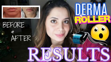 Derma Roller Before And After Unbelievable Results Youtube