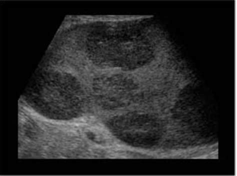 Spleen Pathology Ultrasound Images Flashcards Quizlet