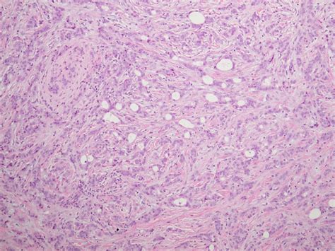 Ectopic Breast Carcinoma Presenting As Sebaceous Cyst Left Axilla Bmj