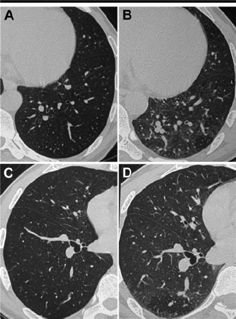 Typical Transverse Ct Images Obtained In A B A Current Smoker And