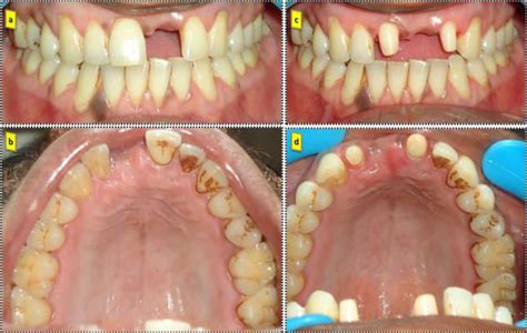 Intra Oral Examination Showing Missing Maxillary Left Central Incisor